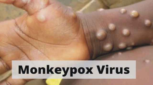 monkeypox